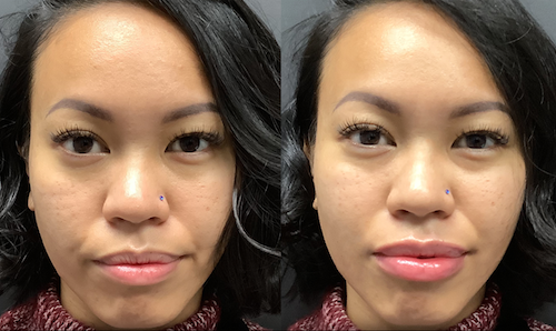 Lip Filler Symmetry Enhancement Before After Oakville Lip Doctor